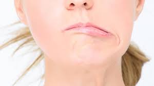 شلل الوجه النصفي تعطل مفاجئ للعضلات | ملحق الصحة و الطب | ملاحق الخليج