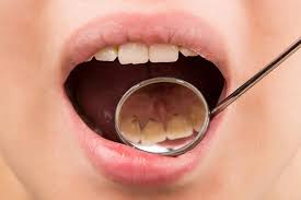 طرق بسيطة تخلصك من الرواسب السوداء على الأسنان | الكونسلتو
