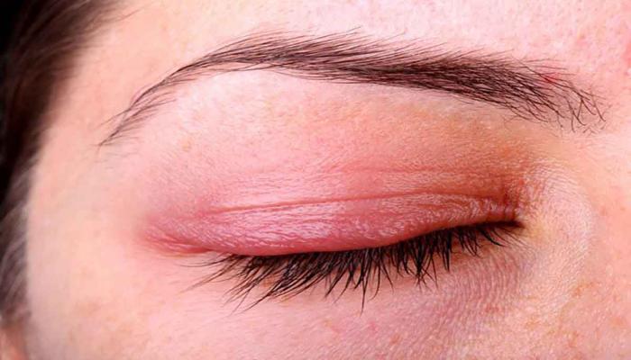 انتفاخ جفن العين ما هي أسبابه واعراضه والمخاطر التي يسببها وكيف يتم علاجه ؟