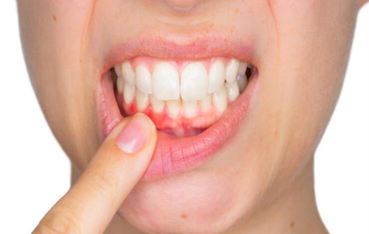 اسباب نزيف اللثه أهم اسباب التهاب ونزيف اللثه وطرق علاجه